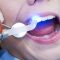 Are You Aware About Dental Sealants?