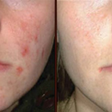 Get Rid Of Your Acne with IPL Treatment