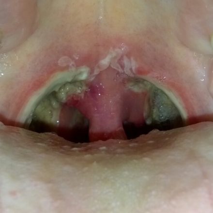 Is tonsillectomy the right option?