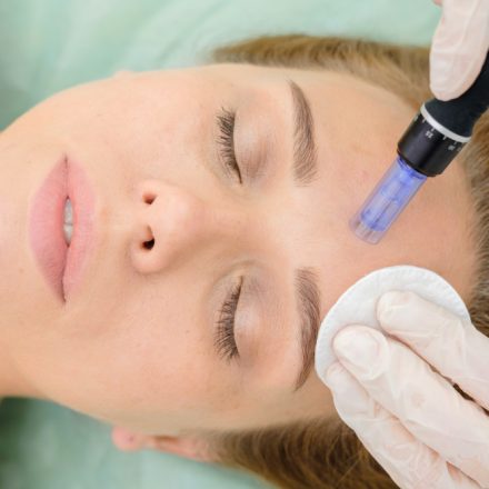 All about microneedling procedure
